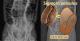 老翁腹部X光顯示乙狀大腸異常脹大，呈現像咖啡豆般的腸氣影像