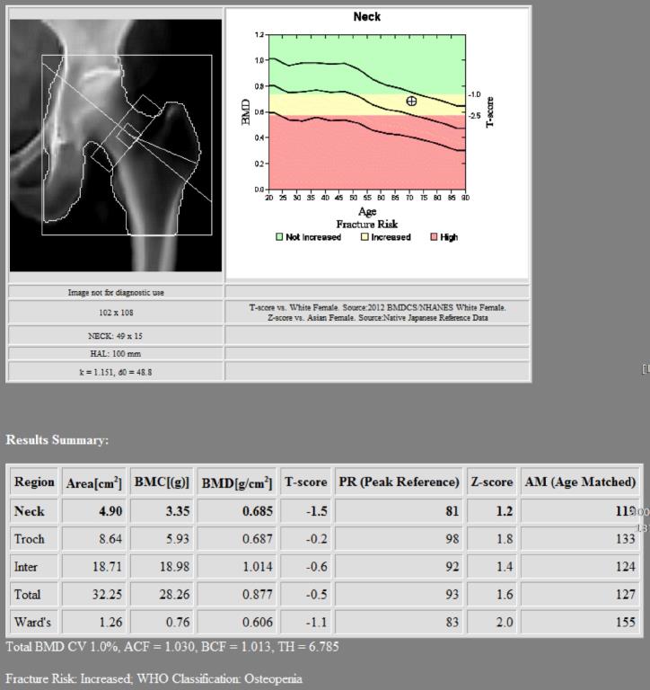骨密度攝影1 骨密度攝影1