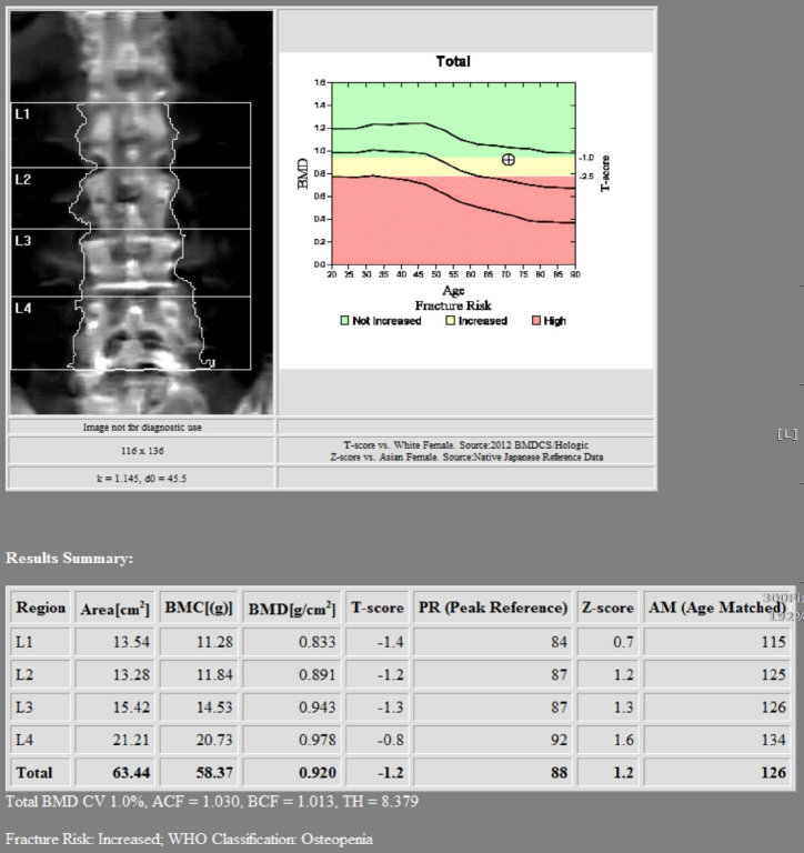 骨密度攝影2 骨密度攝影2